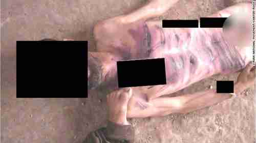 Emaciated man showing wounds from repeated beatings by rod-like object.  There are 55,000 photos like this, showing 11,000 corpses from Bashar al-Assad's psychopathic torture.