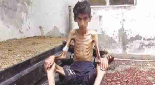 Starving boy found by aid workers in Madaya, Syria